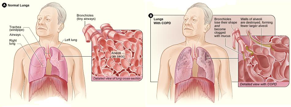 copd
