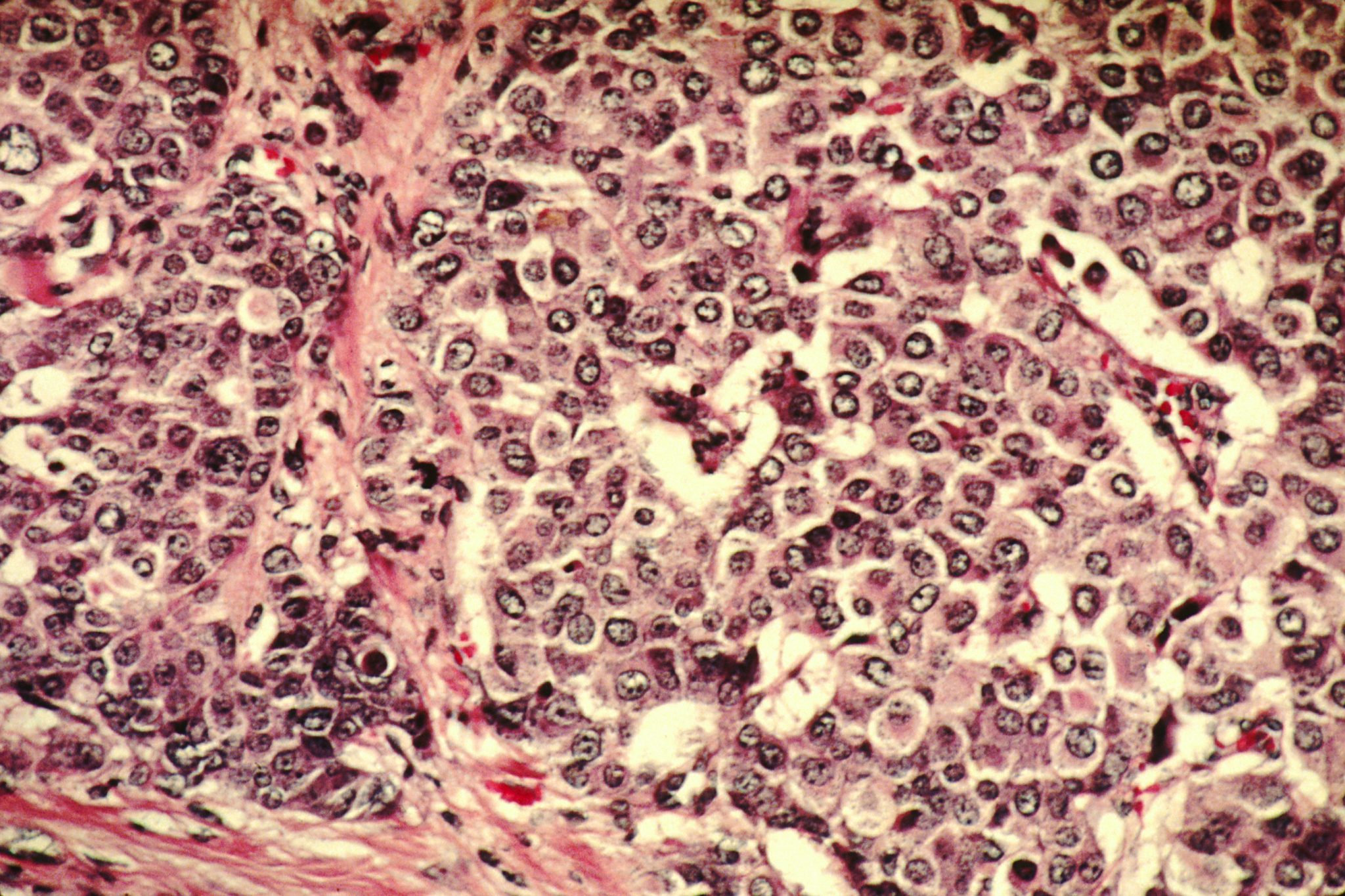 breast cancer